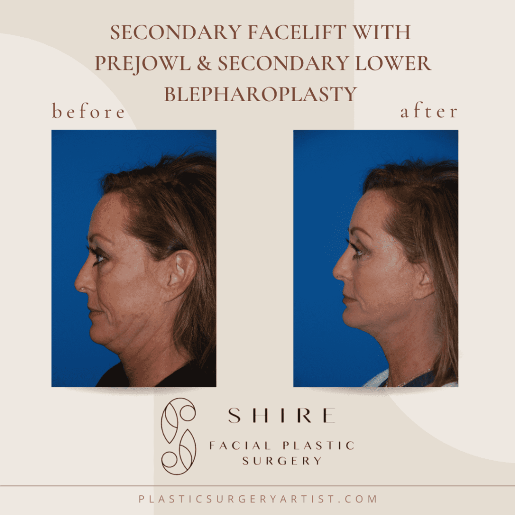 secondary facelift with prejowl and secondary lower blepharoplasty