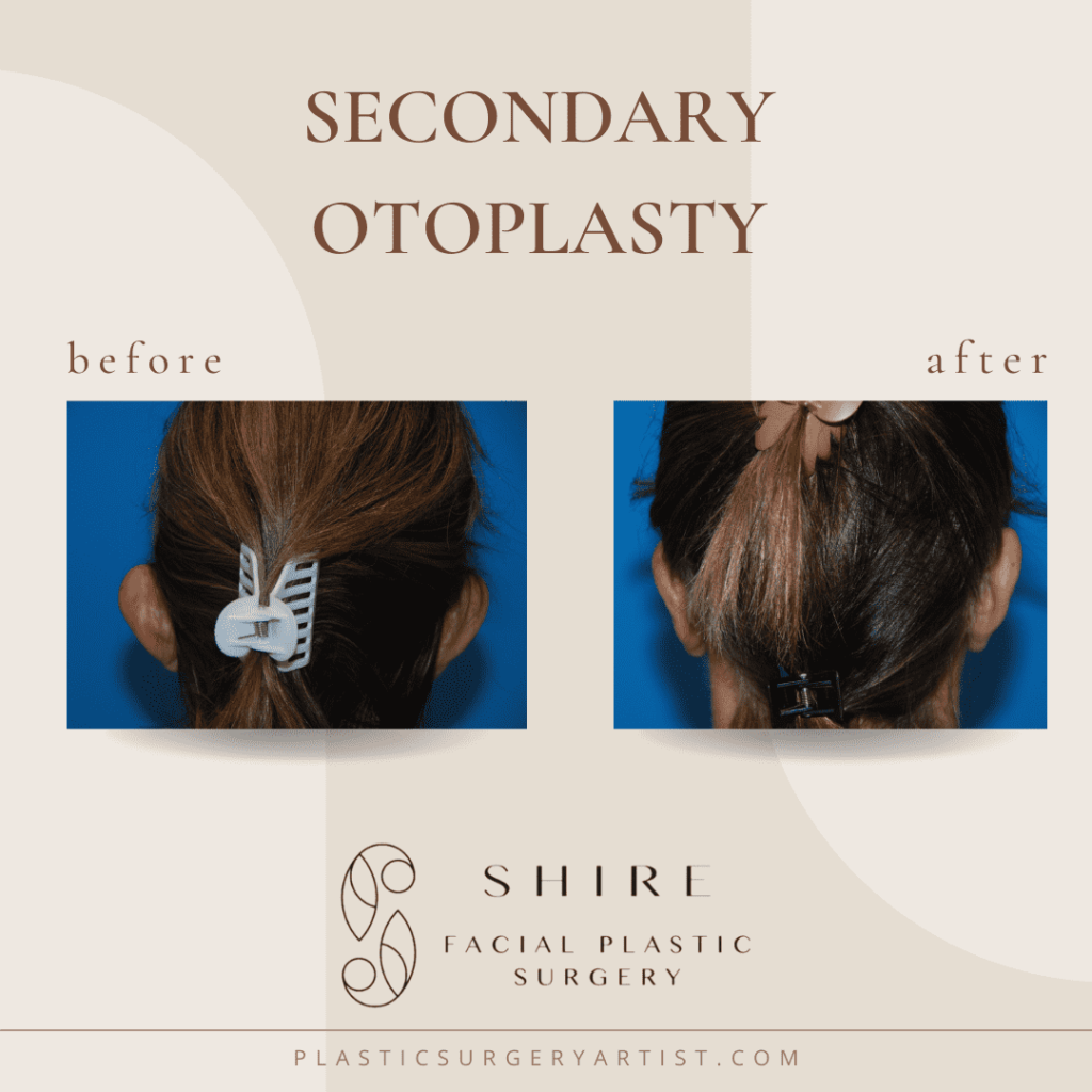 secondary otoplasty