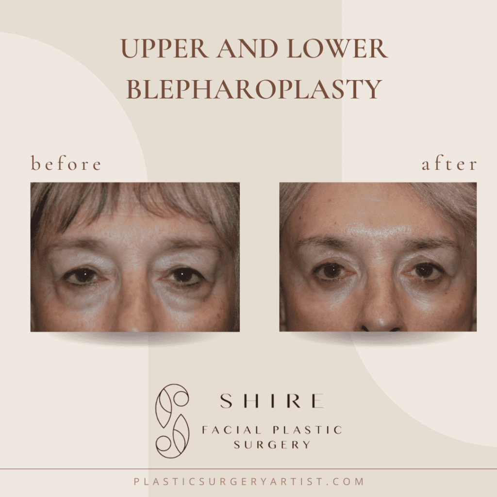 upper and lower blepharoplaty