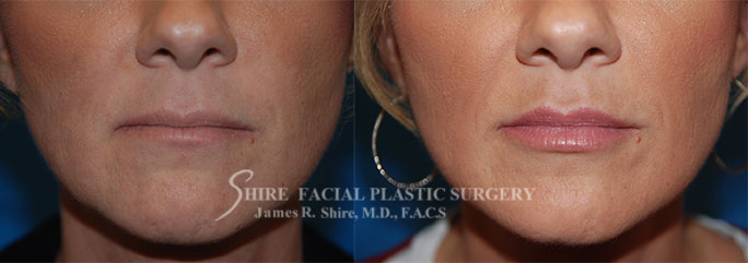 Juvederm-FB Juvederm-FB