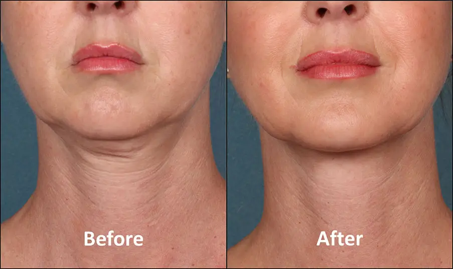 kybella-before-after_front kybella-before-after_front