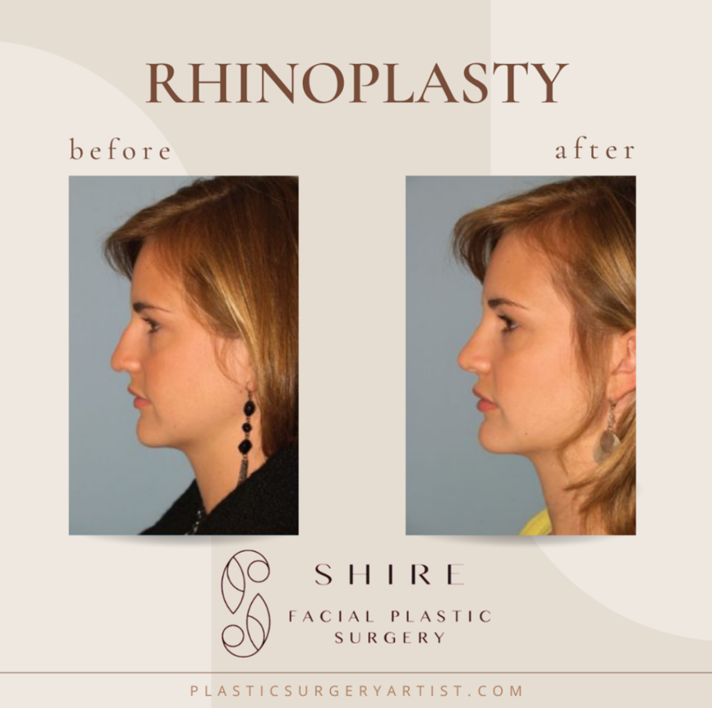 Dorsal Hump and Nasal Tip for a Natural Result