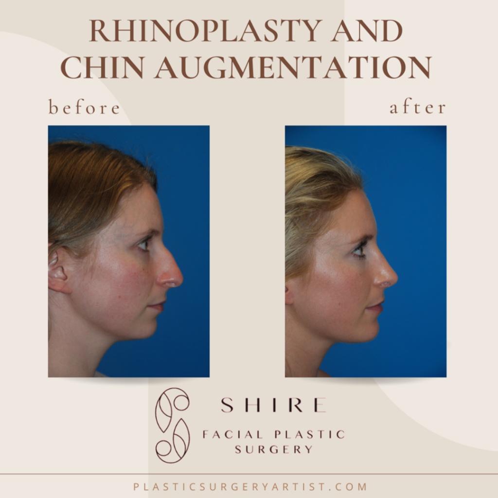 Rhinoplasty and Chin Augmentation