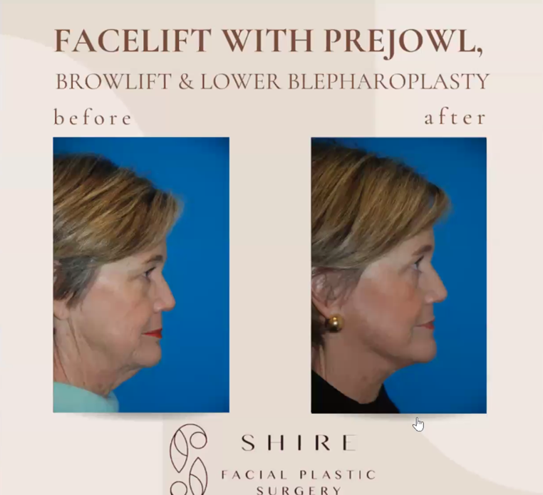 facial rejuvenation brow lift eyelid surgery