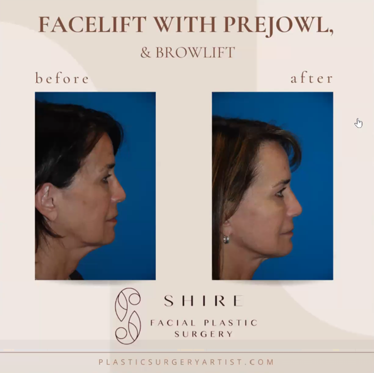 lower facelift jowls neck laxity