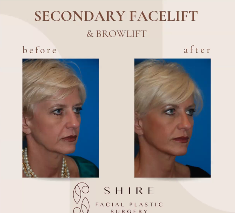refreshed youthful appearance lower facelift neck lift